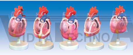 The model of congenital heart deformity (5parts)